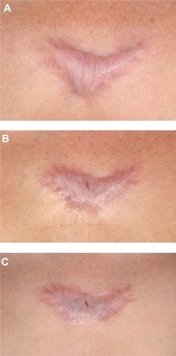 Figure 2 Patient with keloid in the presternal area resistant to cryotherapy and TAC, silicone gel sheeting, surgery and postoperative radiotherapy (recurrence) suffering from severe pruritus at baseline (A). Significant reduction of pruritus and flattening after 1 week of injection with 5-FU (50 mg/mL) and TAC (40 mg/mL), 3:1 (B). Result at 6 months after the last injection (two injections total), with no signs of recurrence, no pruritus (C).