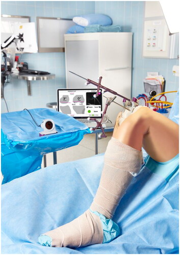 Figure 1. Intra-operative set up of Intellijoint KNEE during the femur cut verification step. The 3D mini optical navigation device consists of an infrared camera within the sterile field which tracks markers on the bone tracker (mounted on the femur or tibia) and the probe tracker which fits into the cutting guide slot to verify the cut. Data is relayed to the computer workstation outside of the sterile field and displayed in real time. The device can be controlled by the surgeon with the buttons on the camera or by an assistant at the workstation.