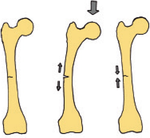 Figure 9. Why incomplete atypical fractures do not heal: loading could open and close the gap.