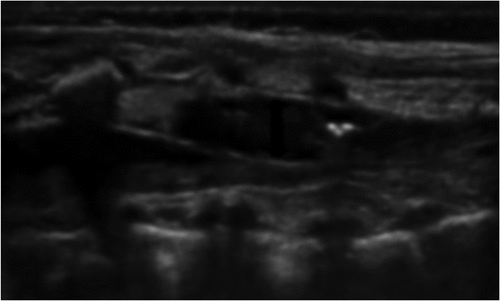 Figure 1. Widening epidural space