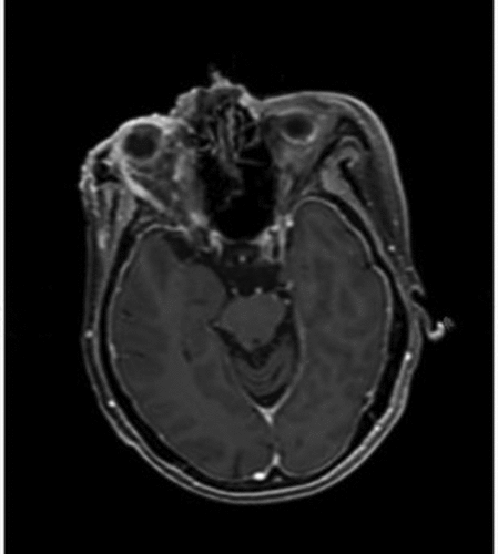 Figure 8. Cranial MRI after four cycles of anlotinib hydrochloride, showing a significant reduction in the density of the right orbit malignance.