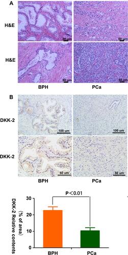 Figure 1 Expression of DKK-2 in human PCa and BPH tissues. (A) H&E staining of the tissues. (B) Immunostaining for DKK-2 and quantitative analysis (P<0.01 versus BPH).