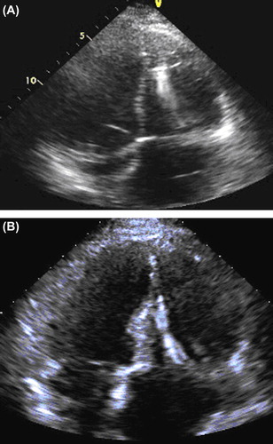 Figure 2. Echocardiogram after third myocardial infarction compared with study at 18-month follow-up.