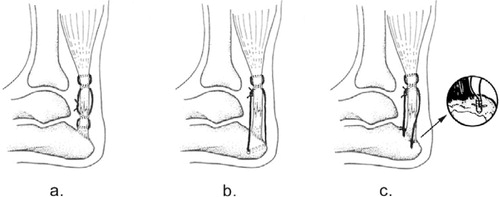 Figure 1. Schematic drawing of suture techniques:a.open method with Bunnell sutures, b. calcaneal tunnel method, c. bone anchor method.