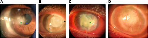 Figure 1 Clinical signs of fungal corneal ulcer: Early fungal ulcer with feathery borders (blue arrow), Stromal infiltration (green arrow) (a). Advanced central fungal ulcer with satellites and dense infiltration (Black arrow) (b). Advanced fungal ulcer with dense infiltration (Green arrow), satellites (Black arrow), and hypopyon (Yellow arrow) (c). Corneal Opacification and vascularization following fungal ulcer (d).