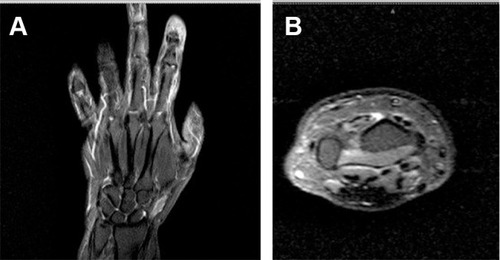 Figure 3 MRI imaging coronal (A) and axial (B) views show an empty 3d extensor compartment with no EPL tendon at Lister’s tubercle level.