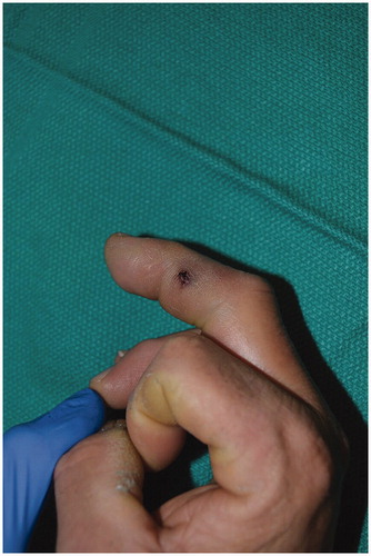 Figure 1. Entrance wound on the radial aspect of the right long finger middle phalanx.