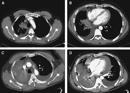 Figure 1.  Radiological images before cetuximab treatment. Chest CT before treatment (A, B) and after 1 cycle of chemotherapy (C, D), demonstrating aggravation of pericardial effusion, bilateral pleural effusion, and right lobe consolidation.