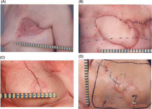 Figure 1. a. Split-thickness graft, b. Latissimus dorsi flap, c. Transverse rectus abdominis muscle, d. Rhomboid flap.