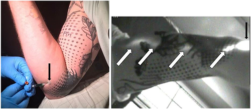 Figure 1 Normal lymphatic drainage at the level of the upper limb. On the right sided black and white figure (oblique inferior and posterior view centered on the arm), NIRFI shows fluorescent lymphatic vessel (oblique arrows) running directly under the tattooed area towards the axilla and after the intradermal injection of ICG at the level of the posterior part of the forearm under the elbow (see vertical arrows on the left sided picture) in subject j6.
