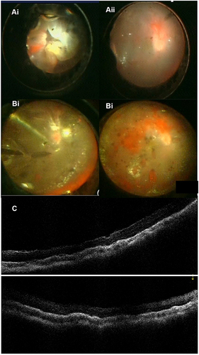 Figure 2 A 14 years-old boy with complex retinal detachment. (A) First surgical procedure, intraoperative fundus photography. (Ai) Before vitrectomy: retinal detachment with advanced proliferative vitreoretinopathy. (Aii) End of vitrectomy: total tamponade of the retina with perfluorocarbon liquid and silicone oil. (B) Second surgical procedure, intraoperative fundus photography (Bi) Perfluorocarbon liquid – silicone oil exchange. (Bii) Retinal tamponade with silicone oil. (C) Postoperative optical coherence tomography after 1 month: macular reattachment.