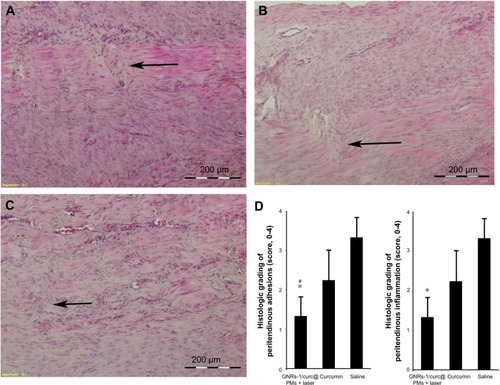 Figure 5 Representative histology after treatments and laser exposure.Notes: (A) GNRs-1/curc@PMs + laser group. (B) Curcumin group. (C) Saline group. Arrow: tendon healing site. (D) Histological grading of peritendinous adhesion and inflammation: *P<0.01 vs curcumin group and #P<0.01 vs saline group. Student’s t-tests assuming unequal variance were performed. The results were expressed as mean values ± standard deviation.