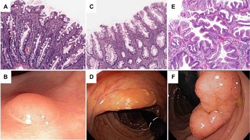 Figure 2 Endoscopic and histologic appearance of serrated polyps including (A, B) a microvesicular hyperplastic polyp, (C, D) sessile serrated polyp, and (E, F) traditional serrated adenoma.