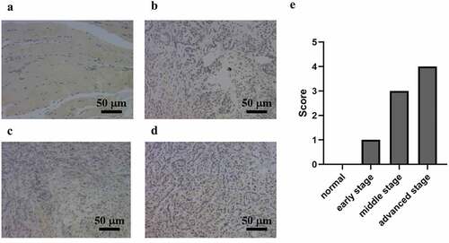 Figure 1. AGP expression at different stages of breast cancer in tumor tissues and adjacent normal tissues detected using immunohistochemistry (×200). (a) normal adjacent tissue. (b) early-stage breast cancer tissue. (c) middle-stage breast cancer tissue. (d) late-stage breast cancer tissue. (e) scoring of immunohistochemistry results for AGP in each sample.