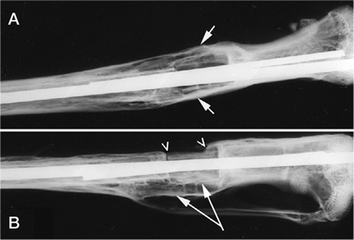 Figure 4. Radiographs of the operation site at 20 weeks. (A) Formation of bridging callus (arrows); anteroposterior view. (B) Posteriorly, strong callus formation; double cortex (long arrows). Anteriorly, resorptive rounding and a gap at the distal junction (arrowheads), bridging callus over the proximal junction; lateral view. Both images show the intra-medullary K-wires still in place.