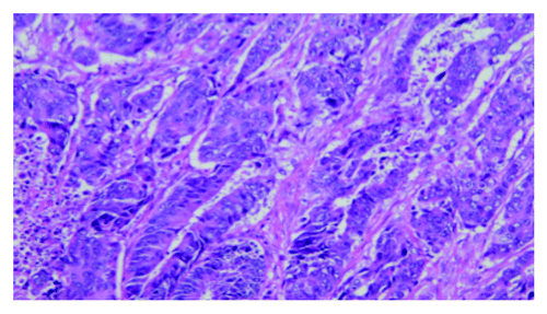 Figure 1. Pathology showed a moderately differentiated adenocarcinoma in the rectum with direct extension to the ovary and uterus at the time of recurrence (H&E, 200× original magnification).