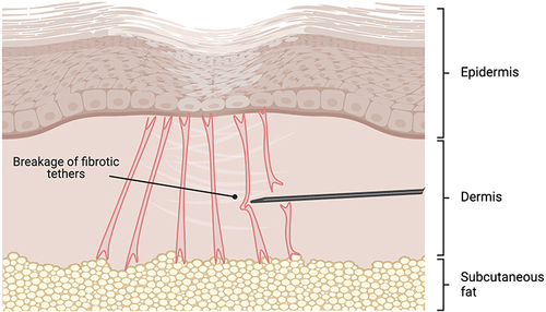 Figure 2 Overview of subcision.