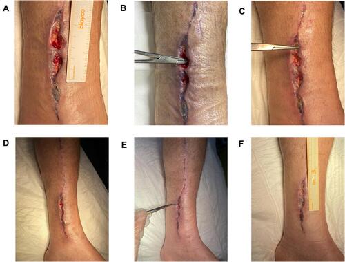 Figure 5 Representative images of wound during healing process. (A) Day 10, (B) Day 13, (C) Day 16, (D) Day 20, (E) Day 23, (F) Day 27.