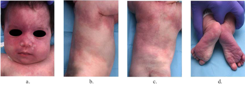 Figure 2 GNAQ SWS phenotype. Extensive facial Port-Wine birthmark with geographical and sharp borders (a). Presence of additional and extensive capillary malformations of the anterior, lateral and posterior trunk (b and c). Bilateral and symmetrical involvement of the plantar aspect of both feet (d).