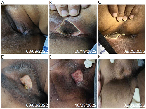 Figure 3 Changes of the infected perianal skin. (A) showed perianal purulent spot formed on day +6. (B) showed perianal abscess with local rupture on day +8. (C) showed giant perianal ulcer after infection control on day +21. (D), (E) and (F) showed the recovery of perianal ulcer.