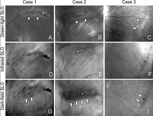 Figure 8 Scanning laser ophthalmoscopy in lattice degeneration. (A) Green-light scanning laser ophthalmoscopy (SLO) shows moderately pigmented perivascular lattice degeneration lesion (arrowheads). (B) Green-light SLO shows mildly pigmented perivascular lattice degeneration lesion (arrowheads). (C) Green-light SLO shows non-pigmented concentrical lattice degeneration lesion (arrowheads). (D) Infrared SLO shows pigmentary clusters (asterisk) in moderately pigmented perivascular lattice degeneration lesion. (E) Infrared SLO shows mild pigmentary clusters (asterisk) in mildly pigmented perivascular lattice degeneration lesion. (F) Infrared SLO shows a few pigmented granules in concentrical lattice degeneration lesion (arrowheads). (G) Dark-field SLO shows mild dark region around perivascular lesion (arrows). (H) Dark-field SLO shows large dark region beneath the lesion (arrows). (I) Dark-field SLO shows subtle dark region within concentrical lattice degeneration lesion (arrows).