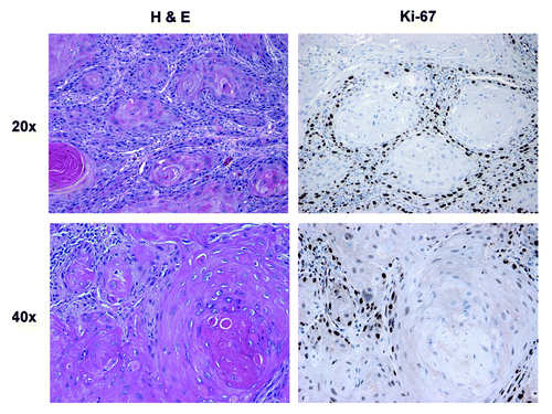 Figure 3. Morphology and proliferation in well-differentiated HNSCC tumor tissue: H&E and Ki-67 immunostaining. Note that carcinoma cells are more differentiated in the center of clusters or nests, with occasional keratin pearls. The carcinoma cells in the periphery of the nests stain strongly for Ki-67, which is absent in the center of the nests. Original magnification: 20× and 40×, as indicated.