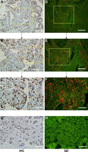 Figure 2 TOP2A expression with IHC and QD-based immunofluorescent imaging.Notes: TOP2A expression with IHC (A–C and G) and QD-based immunofluorescent imaging (D–F and H) at high resolution. TOP2A expression in triple-negative breast cancer (TNBC) tissue was obvious and dense (A–F), while the TOP2A expression in normal mammary tissue was weak and sparse (G and H). The yellow box is used to show the magnified area for the next image. Scale bar =100 μm (A, D, G, and H), 50 μm (B and E), and 25 μm (C and F).Abbreviations: TOP2A, topoisomerase 2 alpha; IHC, immunohistochemistry; QD, quantum dot.