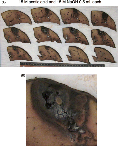 Figure 2 Gross specimen of thermochemical ablation using 0.5 mL each of acetic acid and sodium hydroxide at 15 mol/L. (A) Formalin-fixed sections laid out adjacent with ruler, (B) Magnified view of gross specimen, middle row, second from left. Pale ovoid central structure is a piece of spaghetti used to mark the tract and assist with haemostasis during the experiment. A charred appearance with some cavitation is evident.