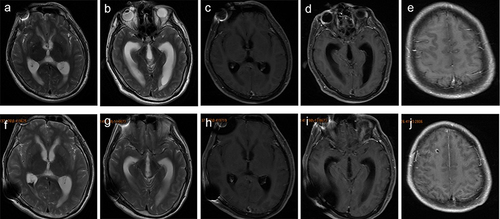 Figure 3 Brain magnetic resonance imaging of patient 2. Brain magnetic resonance imaging showed hydrocephalus (a and b) and leptomeningeal enhancement (c–e) 1 month after clinical onset. The hydrocephalus (f and g) and leptomeningeal enhancement (h–j) were slightly alleviated after ventriculo-peritoneal drainage and antibiotic treatment.