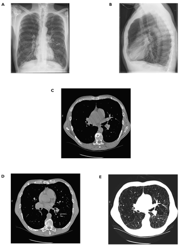 Figure 3 A. Posterior-anterior chest X-ray and B. Lateral chest X-ray demonstrating enlarged pulmonary arteries and severe hyperinflation. The metallic opacification is a left nipple ring. C. Chest CT scan at the level of the pulmonary outflow tract demonstrating a main pulmonary artery diameter greater than the adjacent aorta. D. Chest CT scan at the level of the lower lobes demonstrating segmental pulmonary arteries that are larger than the accompanying bronchi. E. Chest CT at the same level as Figure 3C using parenchymal windows to demonstrate severe emphysematous changes throughout the lung parenchyma.