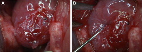 Figure S5 (A) Infarcted area after the ligation. (B) Transplantation of the NPC-ADMSC in the peri-infarcted area of the left ventricular wall.Abbreviations: NPC, curcumin-loaded polycaprolactone nanoparticles; ADMSC, adipose-derived mesenchymal stem cells.