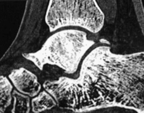 Figure 1. In the sagittal plane, the center of the ankle is defined as the high point of the talar dome and the corresponding high point of the tibial articular surface.