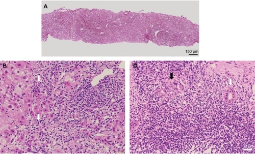Figure 2 Needle biopsy specimen of the liver.Notes: A) Low magnification of silver impregnation staining for reticulin showing broad areas of parenchymal collapse. B) High magnification of a hematoxylin and eosin stained section showing interfacial hepatitis (arrow). C) High magnification of a hematoxylin and eosin stained section showing non-destructive cholangitis (black arrowhead) and destructive cholangitis (white arrowhead) surrounded by numerous plasma lymphocytic cells.
