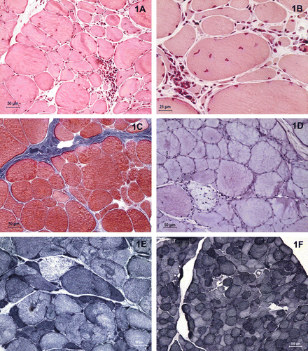 Figure 1.  Transverse sections of deltoideus (A–E) and vastus lateralis (F) muscles from a three-year-old dog with a Labrador retriever myopathy stained with histochemical and enzymatic reactions: (A, B) the haematoxylin and eosin stain showing the variability in myofibre size, the presence of an inflammatory infiltrated and the characteristic internal nuclei. (C) Modified Gomori trichrome stain demonstrating the increment of connective tissue. (D) Periodic acid–Schiff reaction showing a necrotic myofibre with pale appearance. (E, F) Increase of the oxidative activity and altered mitochondrial pattern is showed by nicotine adenine dinucleotide tetrazolium reductase reaction.