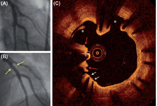 Figure 1. (Patient 1) (A) Coronary angiogram from a woman treated in the left anterior descending artery by a sirolimus eluting Cypher Select+ stent (Cordis, USA). The patient is readmitted due to acute coronary syndrome 15 months after the index procedure. (B) Peri-stent contrast staining is identified, but no thrombus or (re-)stenosis. (C) Optical coherence tomography of the implanted stent shows evaginations (green asterixes), red thrombus (red arrows), and uncovered stent struts (white arrows). Guide wire is marked with blue asterix.