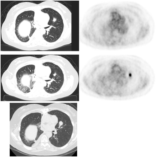 Figure 3. Lung cancer recurrence. (Top) FDG PET/CT 1 month post-RFA shows low level uptake at treatment site in the left upper lobe. (Middle) FDG PET 7 months post-RFA shows focal intense uptake at ablation zone (increased compared to immediate post-RFA FDG PET), suspicious for recurrence. Concurrent diagnostic CT showed no evidence for recurrence, and possibly even slightly contracted soft tissue. (Bottom). Follow up diagnostic CT 10 months post-RFA showed enlargement of soft tissue at ablation zone, confirming recurrence.