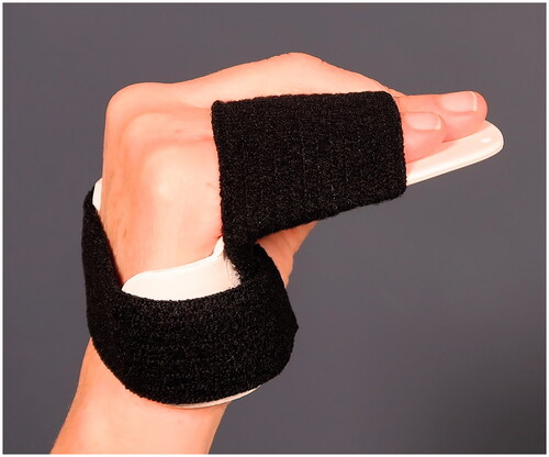 Figure 2. Hand-based thermoplastic splint to be worn at night and in unprotected environments from cast removal until follow-up at 6 weeks.