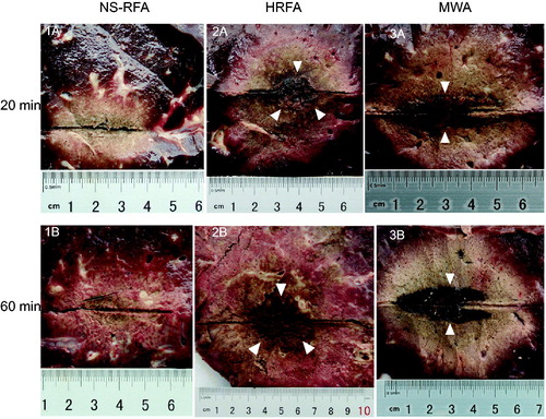 Figure 2. Macroscopic photographic images, longitudinal view, of characteristic ablation zones after normal saline infusion radiofrequency ablation (NSRFA), hydrochloric acid infusion radiofrequency ablation (HRFA), and microwave ablation (MWA), ablation durations of either (A) 20 min or (B) 60 min. Key findings: [Citation1] NSRFA ablation zone with no silt-like or charring zones identified: (A) 20 min ablation duration: transverse diameter (TD) 2.8 cm × longitudinal diameter (LD) 3.7 cm, spherical ratio (SR) 0.75, ellipsoid shape, (B) 60 min ablation duration: TD 3.2 cm × LD 3.8 cm, SR 0.84, more spherical than ellipsoid shape; [Citation2] HRFA ablation zone with well-distinguished silt-like zone (3 white arrows): (A) 20 min ablation duration: TD 5.4 cm × LD 5.8 cm, SR 0.93, spherical shape, (B) 60 min ablation duration: TD 8.1 cm × LD 8.7 cm, SR 0.93, spherical shape; [Citation3] MWA ablation zone with well-distinguished charring zone (2 white arrows), but no silt-like zone identified: (A) 20 min ablation duration: TD 4.6 cm × LD 6.4 cm, SR 0.71, ellipsoid shape, (B) 60 min ablation duration: TD 6.5 cm × LD 7.3 cm, SR 0.89, ellipsoid shape.