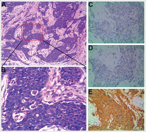 Figure 1. Histopathologic characteristics of the first primary BC of the patient. (A) Hematoxylin and eosin staining (× 100). (B) Hematoxylin and eosin staining (× 400). (C-E) Immunohistochemical staining (× 400). ER (−), PR1 (−), HER2 (2+∼3+).