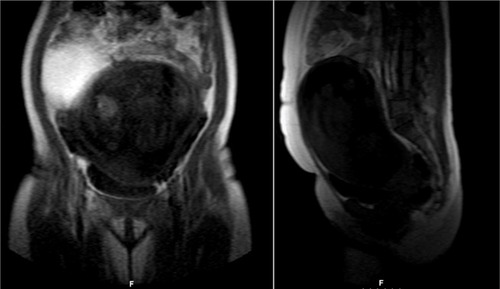 Figure 2 MRI at 20 weeks.