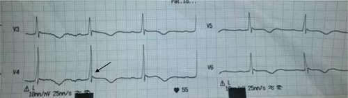 Figure 5 ECG showing bradycardia, prolonged QT interval and Osborn Wave (arrow).