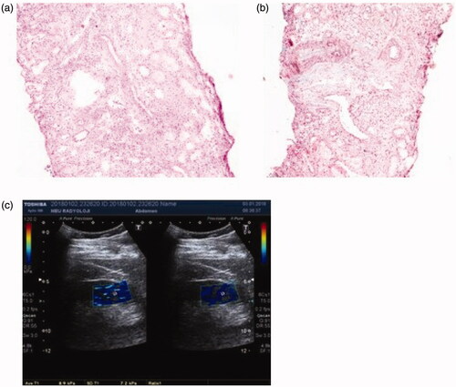 Figure 1. Patient 1: light microscopic images of renal tissue that stage T1 (moderate IFTA)-stage F0 (absence of IF) and their SWE image. (a) H&E ×200. (b) Masson’s trichrome ×200. (c) YM = 7.2 kPa (compatible with the stage F0 (absence of IF)).