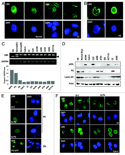 Figure 1. Nuclear irregularity of RCCs is responsible for progerin. (A) The irregularity of the nuclear membrane in human RCC cell line UMRC2 (C2). C2 cells were fixed and stained with Lamin A/C (LMA; green). Nuclear DNA was stained with DAPI (blue). Left panel shows the nuclear morphology of normal fibroblasts (29-y-old healthy subject). (B) Nuclear deformation in HGPS (HS). Cells were also stained with Lamin A/C (LMA; green) and DAPI. (C) Transcriptional expression of progerin (PG) in human cancer cell lines. Expression of progerin was determined by RT-PCR in RCC cell lines (Caki-2, C2, C2V, ACHN, A498, and A704) and non-RCC cell lines (A549 and HCT116) or normal fibroblasts (81-y-old and 29-y-old subjects) compared with HGPS cells (positive control). Because progerin is partially deleted from Lamin A (intra-deletion of 150 bp; arrow), the smaller Lamin A PCR product is progerin (arrowhead). We also confirm that this small band is progerin by cloning-sequencing method. In addition, we showed the relative expression of progerin regarding GAPDH as a graph using a densitometer (see below). (D) Progerin (PG) expression at the translational level in RCC cell lines. WB analysis showed the expression of progerin in C2, Caki-2, A704, and A498 cell lines, but not in A549 and HCT116 at the translation level. HGPS and normal fibroblasts were used for positive and negative controls for PG. We also showed the expression of pVHL and Lamin A/C. Actin was used as a loading control. (E) Si-progerin (Si-PG) ameliorates the nuclear deformation of HGPS (HS). HGPS cells were stained with Lamin A/C after transfection with si-progerin (Si-PG). Si-C indicates scrambled si-RNA. In contrast, progerin transfection induces nuclear deformation in 293 cells (bottom). (F) Si-progerin (Si-PG) ameliorates the nuclear deformation of RCCs. C2 and Caki-2 cells were transfected with si-progerin for 24 h and stained with Lamin A/C and DAPI.