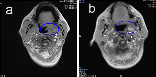Figure 2 The MRI findings of case 2. (A) The swelling (it can be seen in the blue coil) in the left nasopharyngeal wall and rear of the tongue before receiving the PCET regimen. (B) The neoplasm (it can be seen in the blue coil) shrank obviously after 2 cycles completed.