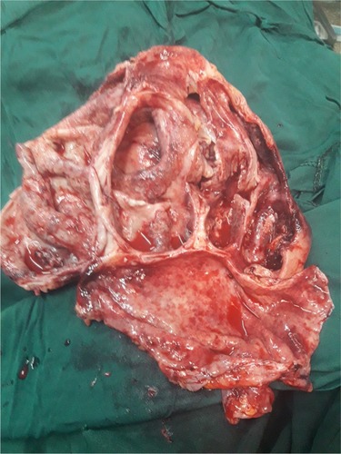 Figure 1 Macroscopic view of the left kidney after nephrectomy was performed.