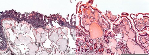 Figure 3 Microscopic picture showing typical changes for PIL: dilated lymphatics in subserosa, submucosa and lamina propria.