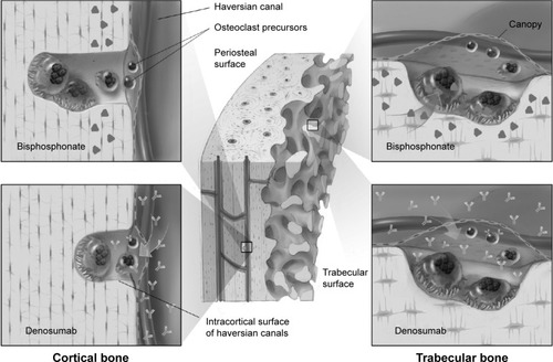 Figure 5 In trabecular bone, osteoclasts engulf matrix containing alendronate, whereas denosumab accesses osteoclasts via the extracellular fluid.