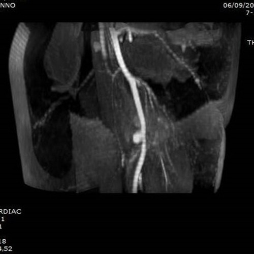 Figure 7 A TOF MRI sequence showing the brachial artery pseudoaneurysm (Case #2).