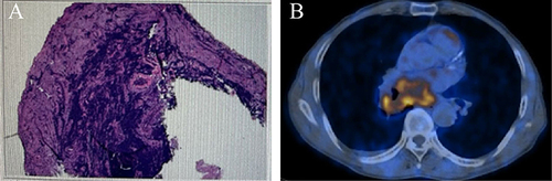 Figure 2 (A) Lesions biopsy by electronic bronchoscopy (B) The image of positron emission tomography (PET)/CT scan showed abnormal soft tissue density in the middle and lower lobes of the right lung near the hilar region with adjacent bronchial stenosis and occlusion, and abnormal concentration of radioactivity distribution in the corresponding area, SUVmax 6.8.