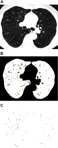 Figure 2 (A) Segmented lung field by setting the threshold between −500 HU and −1024 HU; (B) Converted into binary image where pulmonary vessels were displayed in black with a window level of −720 HU; (C) Mask image after setting the circularity from 0.9 to 1.0 and the vascular size range from 0–5mm2.